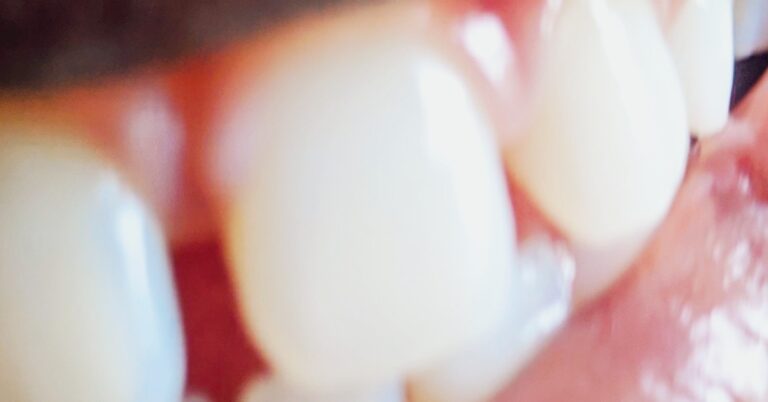 Sparkling white teeth